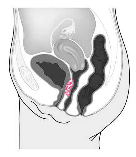 Arvæv mellem vagina og urinveje.